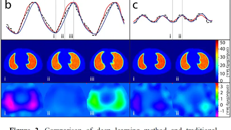 Deep learning based reconstruction enables high-resolution electrical impedance tomography for lung function assessment